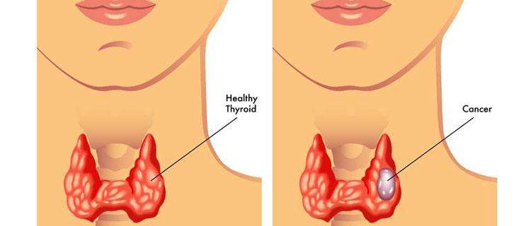 甲狀腺結(jié)節(jié)會(huì)癌變的幾種情況